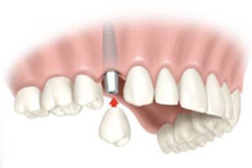 Протезирование зубов на имплантатах в Краснодаре - ДокторСтом